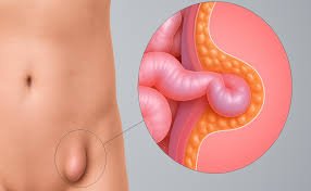 Imagem representativa de hérnia inguinal