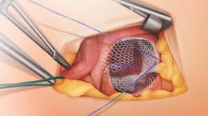Imagem de tela para cirurgia robótica de hérnia abdominal